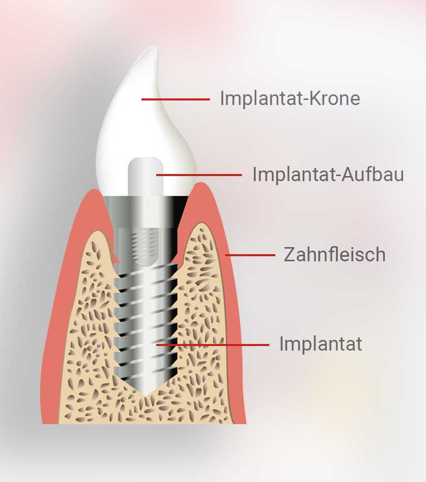 Darstellung des Aufbaus eines Zahnimplantats mit silbernem Implantat, rotem Zahnfleisch, silbernem Implantataufbau und weißer Implantat-Krone