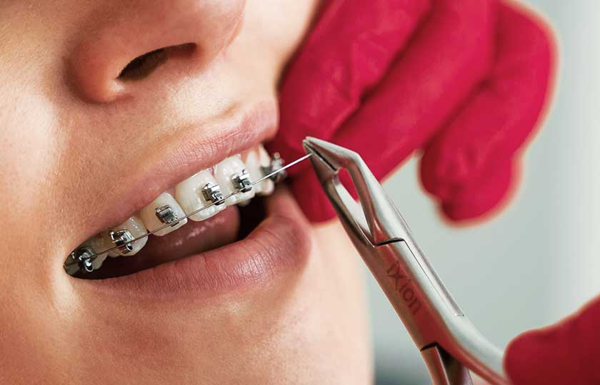 Einsatz von Drähten in die feste Zahnspange einer Patientin im Oberkiefer mit einer Zange